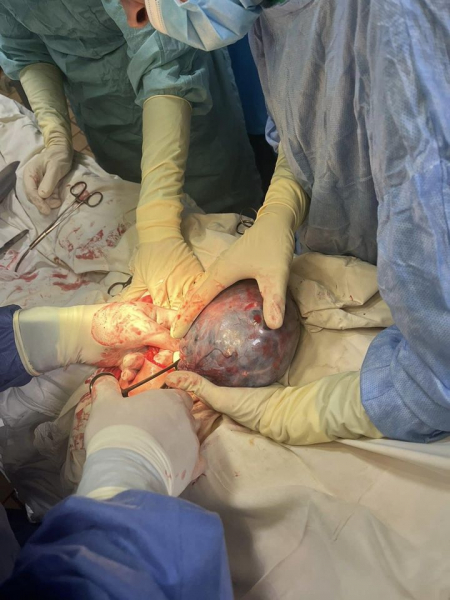 
Врятували пацієнтку від смерті: у Збаражі медики вирізали кісту гігантських розмірів (фото)