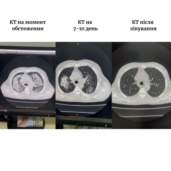 0,5 випадків на 2 мільйони: У Тернополі врятували пацієнта з рідкісною хворобою